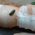 مرکز زالو درمانی شرق تهران